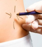 Lipoaspiração Preço