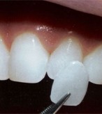 Lente de Contato Dental