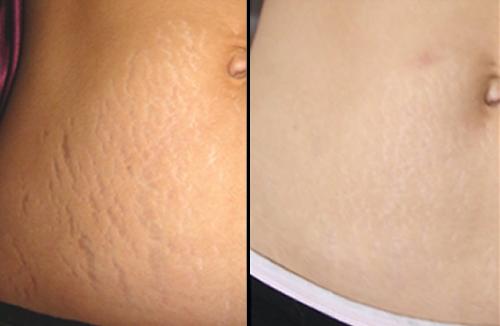 Cicatricure para Estrias foto cicatricure para estrias antes depois Cicatricure para Estrias