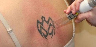 Remoção de Tatuagem a Laser